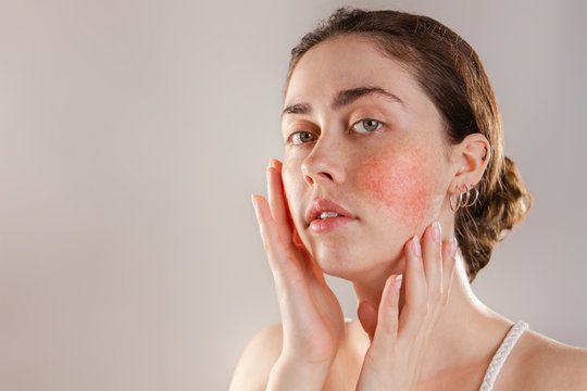 احمرار الانف والخدين بعد التعرض للشمس