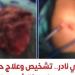 إنجاز طبي نادر، معهد القلب ينجح في تشخيص وعلاج أول حالة موثقة عالميًا لبطانة الرحم داخل الرئة