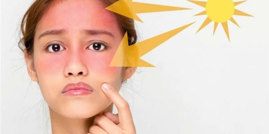 حروق واحمرار وطفح جلدي، هيئة الدواء تحذر من تفاعل هذه الأدوية مع أشعة الشمس