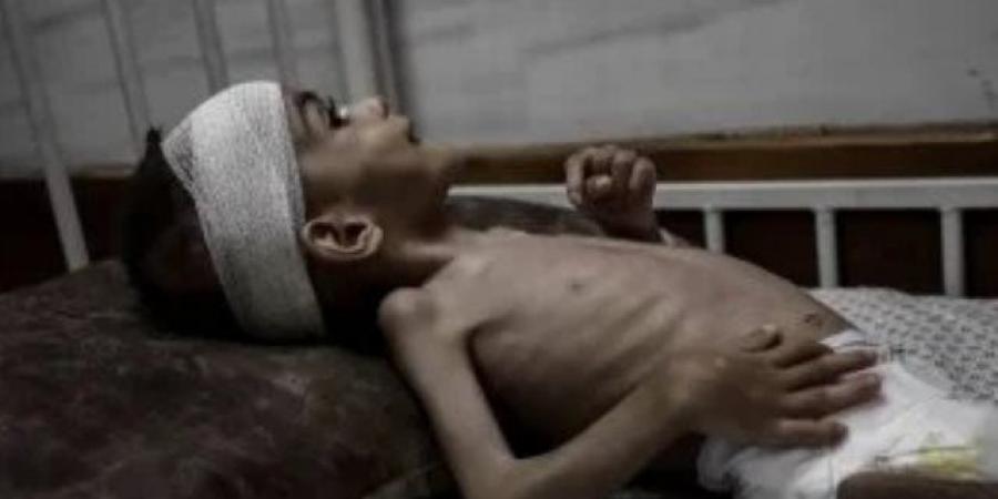 الطفل يوسف الأدهم جسد صغير يواجه معركة قاسية مع سوء التغذية في غزة