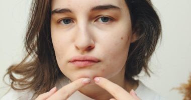 لو بتعانى من حب الشباب.. 3 أطعمة تجنب تناولها