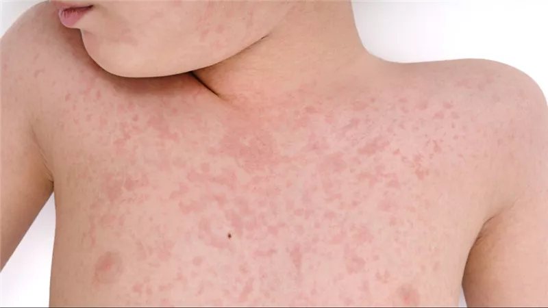 ليس كل طفح جلدي حصبة، الصحة توضح علامات الاشتباه ومتى يجب عزل الطفل
