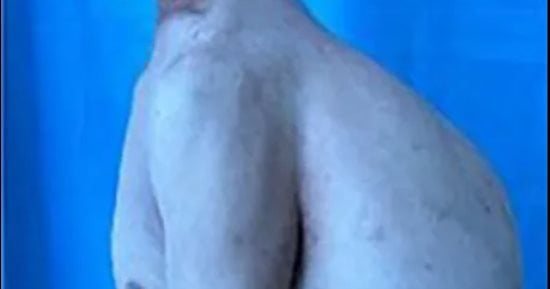 تجاهله لمدة 30 عاما.. إزالة ورم بحجم 3 أطفال رضع من ظهر رجل صيني