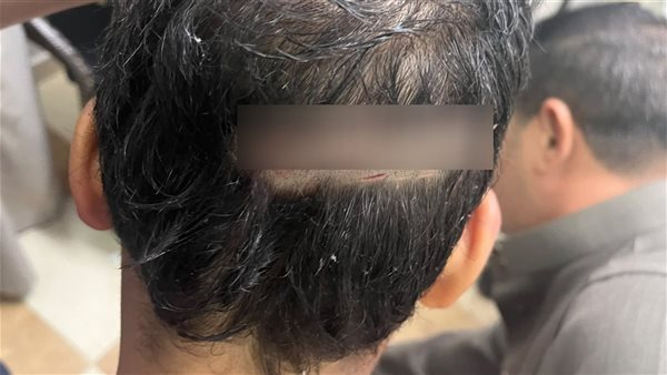 85 غرزة في وجه ورأس تلميذ، مشادة بين طفلين على باب مدرسة تنتهي بمأساة (صور ومستندات)