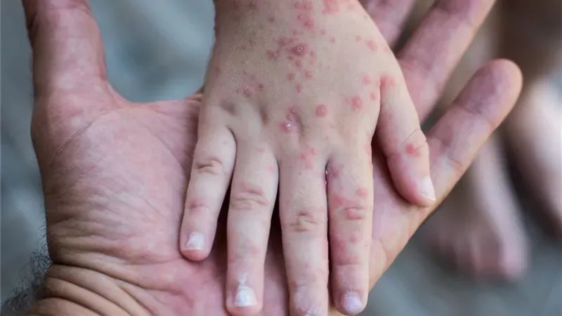 الصحة توضح أعراض الحصبة وطرق العدوى وتحذر من ذهاب الطفل المصاب إلى المدرسة