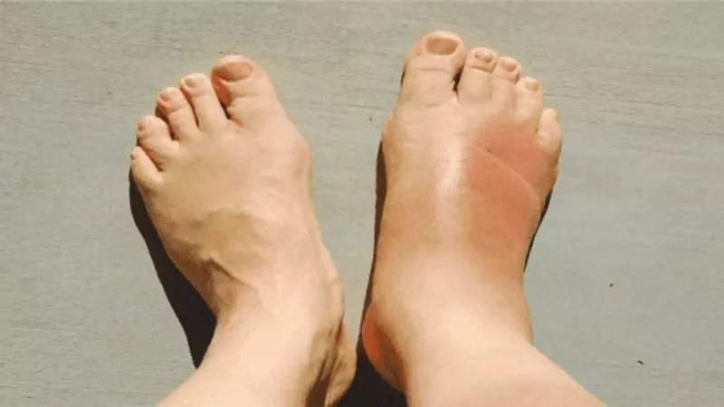 المشي حافيا وحذاء غير مناسب، عادات تهدد أقدام مرضى السكري