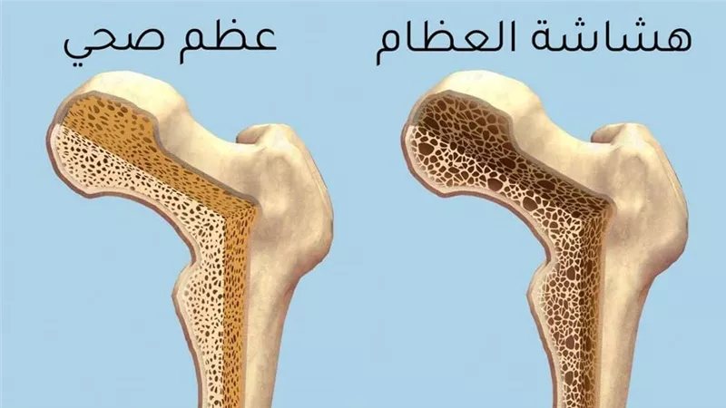 هشاشة العظام عند النساء، الأسباب والأعراض المبكرة وأفضل نظام غذائي للحفاظ على قوة العظام
