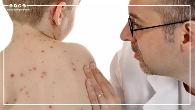 تبدأ كأنها نزلة برد، كيف تكتشف أعراض الحصبة؟